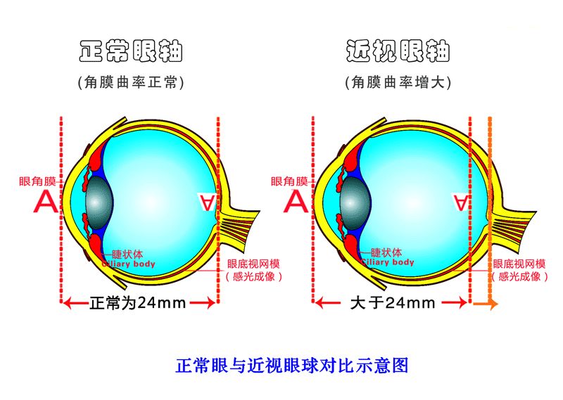 近視是怎樣形成的？視普泰驗(yàn)光師培訓(xùn)學(xué)院帶您走進(jìn)了解
