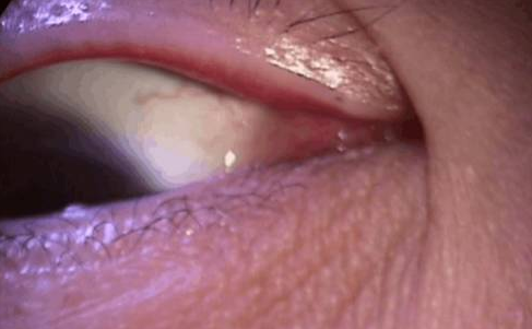 裂縫燈使用流程