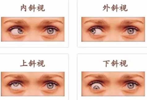 斜視和弱視可以永久治愈嗎？