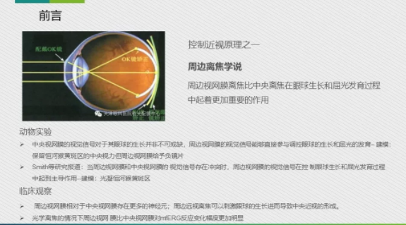 眼科醫(yī)院眼視光醫(yī)師分享角膜塑形鏡的復(fù)診流程