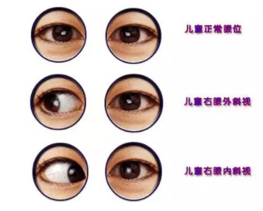 驗光師培訓測試斜視的一些小方法