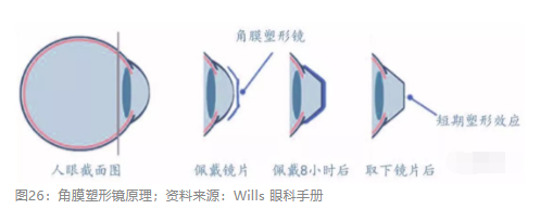 2018眼科行業(yè)報(bào)告：市場有較大增長，消費(fèi)升級推動角塑快速成長