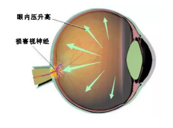 溫醫(yī)大梁遠波教授：大部分失明青光眼患者因就診不及時所致 | 世界青光眼日