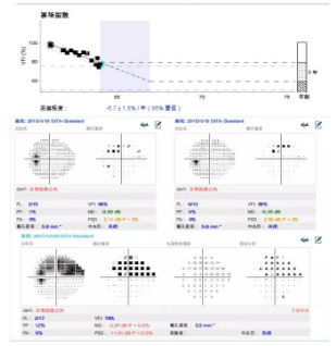 溫醫(yī)大梁遠波教授：大部分失明青光眼患者因就診不及時所致 | 世界青光眼日