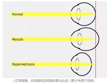 探討青少年近視與電子屏幕關(guān)系，近視關(guān)聯(lián)強(qiáng)因素詳細(xì)分析