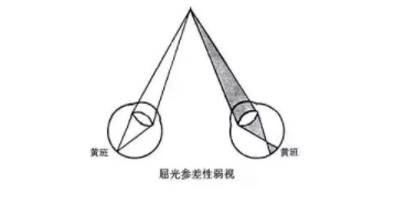 驗(yàn)光師培訓(xùn)不同情況下矯正屈光參差的方法及驗(yàn)光配鏡原則