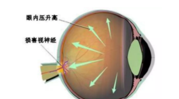 驗光師培訓(xùn)中老年人如何預(yù)防青光眼