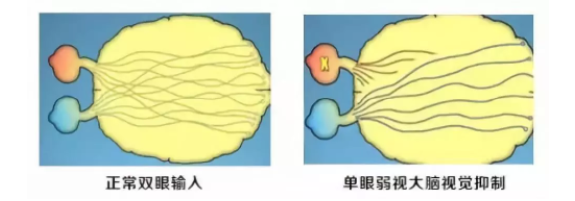 眼視光科普成人的弱斜視會(huì)影響正常生活嗎？