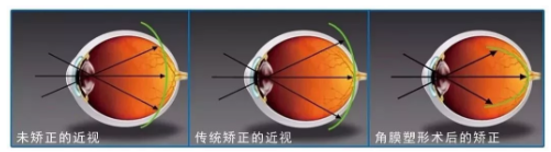 驗光師帶您了解角膜塑形鏡的來龍去脈