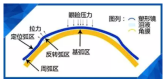 驗(yàn)光師講述孩子戴了角膜塑形鏡近視度數(shù)還會(huì)漲嗎？