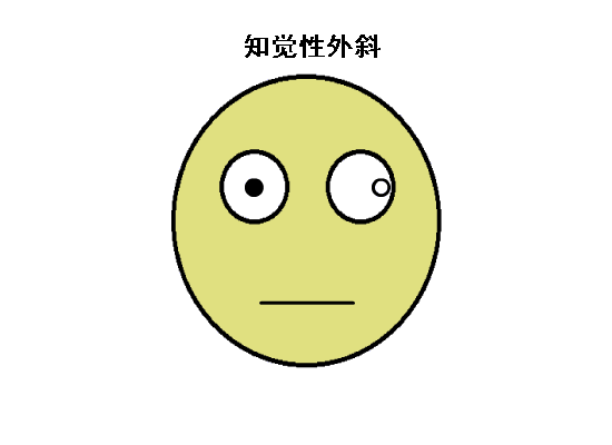 驗光配鏡中遇到的20多種斜視眼位特點