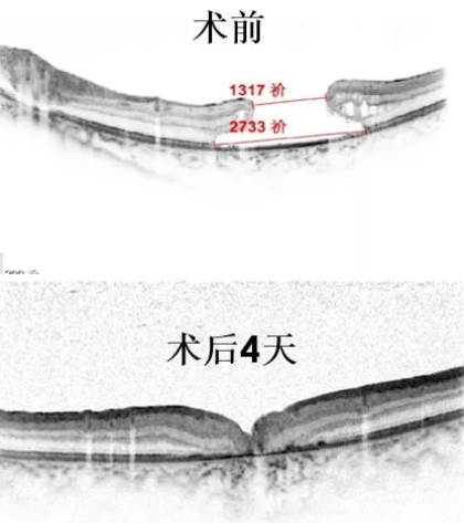 11歲患兒因激光筆損害視網(wǎng)膜造成罕見巨大黃斑裂孔，溫醫(yī)大眼視光成功治愈