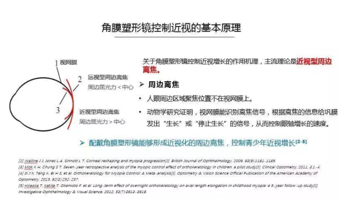 【眼視光前沿】一種具有非球面基弧設(shè)計的角膜塑形鏡