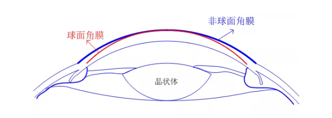 【眼視光前沿】一種具有非球面基弧設(shè)計的角膜塑形鏡